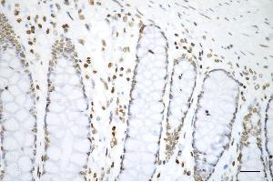 Immunohistochemistry was performed on paraffin-embedded human sigmoid colon carcinoma using histone H3 (di methyl K4) antibody (ABIN7798955), 1:200). (Recombinant Histone 3 抗体  (H3K4me2))