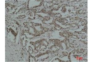 Immunohistochemical analysis of paraffin-embedded Human Breast Carcinoma using Acetyl Lysine Monoclonal Antibody. (Acetylated Lysine 抗体)