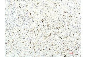 Immunohistochemical analysis of paraffin-embedded Human Breast Carcinoma Tissue using JAK1 Mouse mAb diluted at 1:200. (JAK1 抗体  (AA 960-1040))