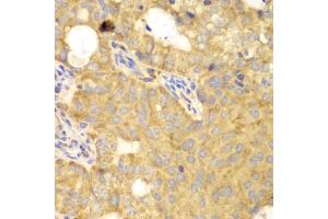 Immunohistochemistry of paraffin-embedded human oophoroma using GNB2L1 antibody (ABIN6292956) at dilution of 1:100 (40x lens). (GNB2L1 抗体)