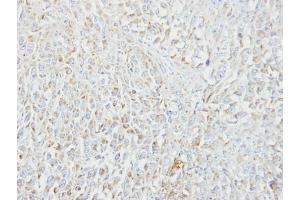 IHC-P Image Immunohistochemical analysis of paraffin-embedded CL1-5 xenograft, using MIPEP, antibody at 1:100 dilution. (MIPEP 抗体)