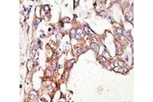 IHC analysis of FFPE human hepatocarcinoma stained with the SUMO4 antibody (SUMO4 抗体)