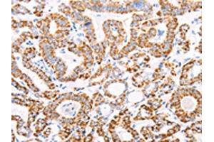 The image on the left is immunohistochemistry of paraffin-embedded Human thyroid cancer tissue using ABIN7128594(ATPIF1 Antibody) at dilution 1/50, on the right is treated with fusion protein. (ATPase Inhibitory Factor 1 抗体)