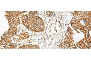 Immunohistochemistry of paraffin-embedded Human colorectal cancer tissue using GNAT1 Polyclonal Antibody at dilution of 1:25(x200) (GNAT1 抗体)