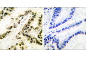 Peptide - +Immunohistochemical analysis of paraffin-embedded human breast carcinoma tissue using AP-2 antibody.