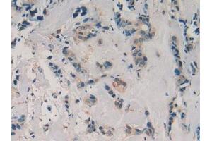 Detection of aZGP1 in Human Breast Cancer Tissue using Polyclonal Antibody to Alpha-2-Glycoprotein 1, Zinc Binding (aZGP1) (AZGP1 抗体  (AA 180-298))