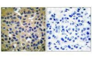 Immunohistochemical analysis of paraffin-embedded human breast carcinoma tissue using Collagen II antibody. (COL2A1 抗体)