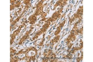 Immunohistochemistry of Human gastric cancer using CYP2E1 Polyclonal Antibody at dilution of 1:30 (CYP2E1 抗体)