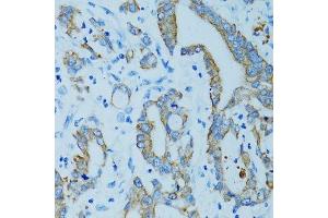 Immunohistochemistry of paraffin-embedded human colon carcinoma using KRT15 antibody.