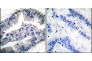 Immunohistochemistry analysis of paraffin-embedded human lung carcinoma, using BIK (Phospho-Thr33) Antibody. (BIK 抗体  (pThr33))