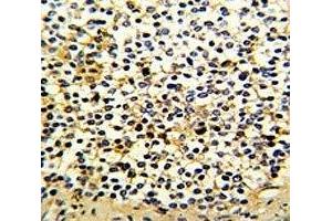 IHC analysis of FFPE human kidney carcinoma with DCXR antibody (DCXR 抗体  (AA 79-106))