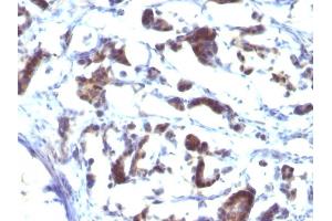 Formalin-fixed, paraffin-embedded human Gastric Carcinoma stained with ZFYVE28 Mouse Monoclonal Antibody (LST2/2426) (ZFYVE28 抗体)