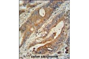 ZBBX antibody (N-term) (ABIN654386 and ABIN2844132) immunohistochemistry analysis in formalin fixed and paraffin embedded human colon carcinoma followed by peroxidase conjugation of the secondary antibody and DAB staining. (ZBBX 抗体  (N-Term))