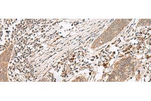 Immunohistochemistry of paraffin-embedded Human esophagus cancer tissue using FUT10 Polyclonal Antibody at dilution of 1:45(x200) (FUT10 抗体)