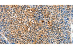 Immunohistochemistry of paraffin-embedded Human liver cancer tissue using SERPINF2 Polyclonal Antibody at dilution 1:50 (alpha 2 Antiplasmin 抗体)