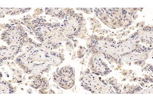 Detection of ACO1 in Human Lung cancer Tissue using Polyclonal Antibody to Aconitase 1 (ACO1) (Aconitase 1 抗体  (AA 251-443))