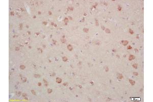 Formalin-fixed and paraffin embedded human gastric carcinoma labeled with Rabbit Anti Annexin A13 Polyclonal Antibody, Unconjugated (ABIN1714416) at 1:200 followed by conjugation to the secondary antibody and DAB staining (CRY1 抗体)