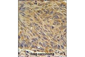 CD99L2 Antibody (Center) (ABIN651686 and ABIN2840361) immunohistochemistry analysis in formalin fixed and paraffin embedded human lung carcinoma followed by peroxidase conjugation of the secondary antibody and DAB staining. (CD99L2 抗体  (AA 39-66))