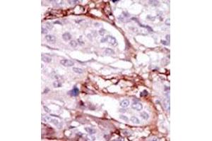Formalin-fixed and paraffin-embedded human cancer tissue (breast carcinoma) reacted with the primary antibody, which was peroxidase-conjugated to the secondary antibody, followed by DAB staining. (STK31 抗体  (N-Term))
