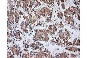 Immunohistochemical staining of paraffin-embedded Carcinoma of liver tissue using anti-VAT1L mouse monoclonal antibody. (VAT1L 抗体)