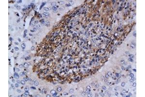 Formalin-fixed and paraffin embedded human cervical cancer labeled with Anti-ATM Polyclonal Antibody, Unconjugated (ABIN685582) at 1:200 followed by conjugation to the secondary antibody and DAB staining (ATM 抗体  (AA 2681-2750))
