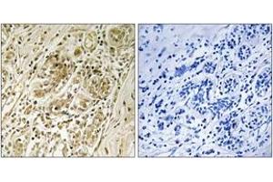 Immunohistochemistry analysis of paraffin-embedded human breast carcinoma, using IRS-1 (Phospho-Ser639) Antibody. (IRS1 抗体  (pSer639))