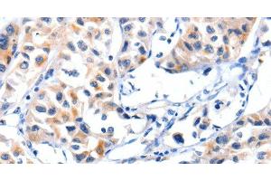 Immunohistochemistry of paraffin-embedded Human lung cancer tissue using Fibulin 5 Polyclonal Antibody at dilution 1:85 (Fibulin 5 抗体)