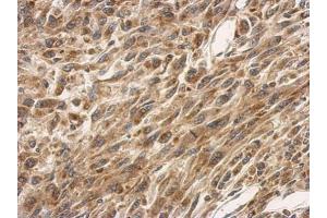IHC-P Image Immunohistochemical analysis of paraffin-embedded U87 xenograft, using SLC25A11, antibody at 1:500 dilution. (SLC25A11 抗体)