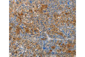 Immunohistochemistry of Human liver cancer using HTRA3 Polyclonal Antibody at dilution of 1:45 (HTRA3 抗体)