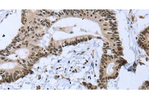 Immunohistochemistry of paraffin-embedded Human colon cancer tissue using ZMAT3 Polyclonal Antibody at dilution 1:30 (ZMAT3 抗体)
