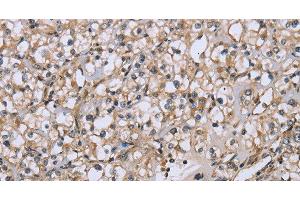 Immunohistochemistry of paraffin-embedded Human prostate cancer tissue using DTNB Polyclonal Antibody at dilution 1:50 (Dystrobrevin beta 抗体)