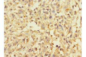 Immunohistochemistry of paraffin-embedded human melanoma using ABIN7144587 at dilution of 1:100 (AVPI1 抗体  (AA 1-147))