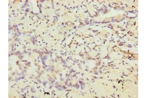 Immunohistochemistry of paraffin-embedded human lung cancer using ABIN7175372 at dilution of 1:100 (VEGFC 抗体  (AA 112-227))