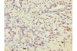 Immunohistochemistry of paraffin-embedded human lung cancer using ABIN7175372 at dilution of 1:100