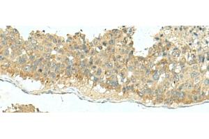 Immunohistochemistry of paraffin-embedded Human liver cancer tissue using KIR2DL5A Polyclonal Antibody at dilution of 1:40(x200) (KIR2DL5A 抗体)