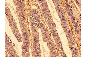 IHC image of ABIN7173825 diluted at 1:400 and staining in paraffin-embedded human colon cancer performed on a Leica BondTM system.