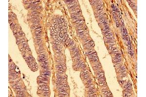 IHC image of ABIN7173825 diluted at 1:400 and staining in paraffin-embedded human colon cancer performed on a Leica BondTM system. (TNFRSF1A 抗体  (AA 263-468))