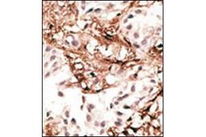 Formalin-fixed and paraffin-embedded human cancer tissue reacted with the primary antibody, which was peroxidase-conjugated to the secondary antibody, followed by AEC staining. (LC3C 抗体  (N-Term))