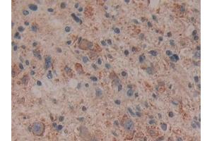 Detection of CYCS in Human Glioma Tissue using Polyclonal Antibody to Cytochrome C (CYCS)