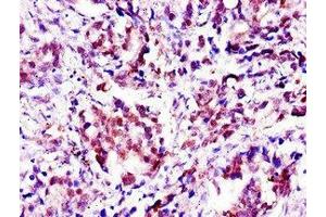 Immunohistochemistry of paraffin-embedded human gastric cancer using ABIN7144491 at dilution of 1:100 (Aprataxin 抗体  (AA 92-161))