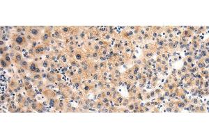 Immunohistochemistry of paraffin-embedded Human liver cancer tissue using GLT8D1 Polyclonal Antibody at dilution of 1:90(x200) (GLT8D1 抗体)