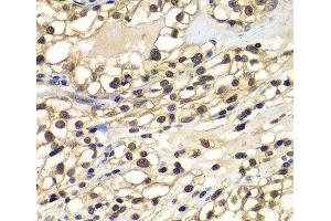 Immunohistochemistry of paraffin-embedded Human kidney cancer using ZNF169 Polyclonal Antibody at dilution of 1:100 (40x lens). (ZNF169 抗体)