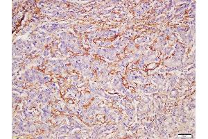 Formalin-fixed and paraffin embedded human gastric carcinoma labeled with Rabbit Anti-CADM2 Polyclonal Antibody, Unconjugated (ABIN1386792) at 1:200 followed by conjugation to the secondary antibody and DAB staining (CADM2 抗体  (AA 125-250))