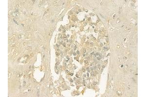 ABIN6261438 and ABIN6276426 at 1/100 staining human prostate carcinoma by IHC-P.
