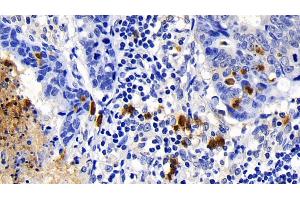 Detection of CASP1 in Human Lymphoma Tissue using Polyclonal Antibody to Caspase 1 (CASP1) (Caspase 1 抗体  (AA 120-297))