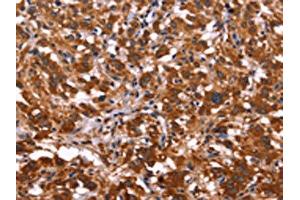 The image on the left is immunohistochemistry of paraffin-embedded Human thyroid cancer tissue using ABIN7128511(ARL4A Antibody) at dilution 1/50, on the right is treated with fusion protein. (ARL4A 抗体)