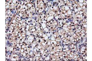 Immunohistochemical staining of paraffin-embedded Carcinoma of Human kidney tissue using anti-SERPINB6 mouse monoclonal antibody. (SERPINB6 抗体)