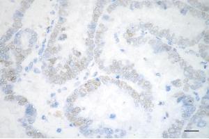 Immunohistochemistry was performed on paraffin-embedded human ovarian carcinoma using chromodomain helicase DNA binding protein 3 antibody (ABIN7798069), 1:200). (Recombinant CHD3 抗体)