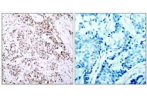 Immunohistochemical analysis of paraffin- embedded human breast carcinoma tissue using Estrogen Receptor-α (Ab-106) antibody (E021066). (Estrogen Receptor alpha 抗体)