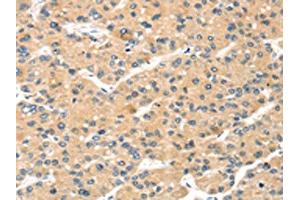 The image on the left is immunohistochemistry of paraffin-embedded Human liver cancer tissue using ABIN7191340(MAGEA11 Antibody) at dilution 1/20, on the right is treated with synthetic peptide. (MAGEA11 抗体)